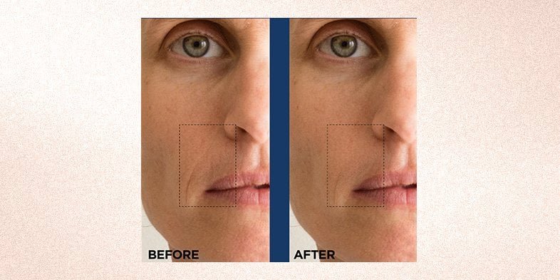 In Article When Should You Start Using Retinol Revitalift 03  Pure Retinol Serum