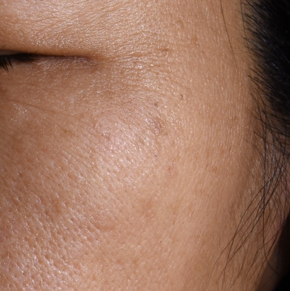 20251105 Oap Revitalift Laser Melasyl Creamy Serum Before Dmi Ecomm Img 1000x1000